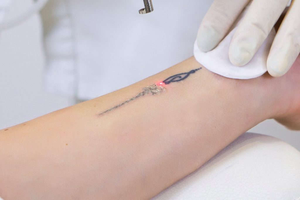 laser-tattoo-removal