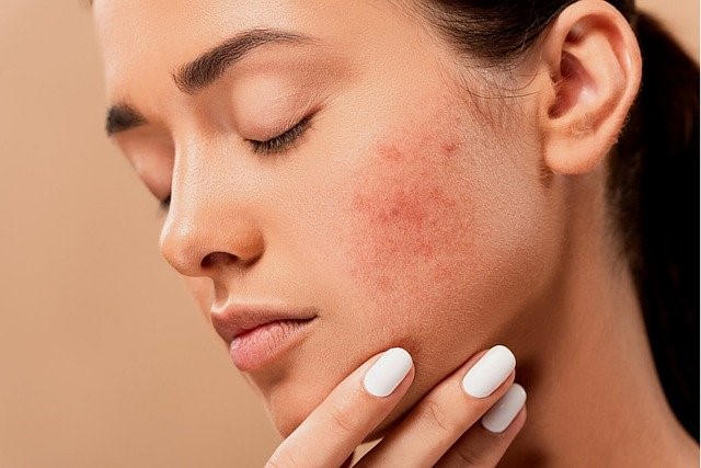 A woman with serious acne scarring on her face