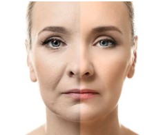 A woman before and after getting radiofrequency facial skin tightening procedure