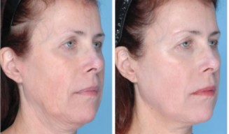 A before and after of a woman receiving ultherapy